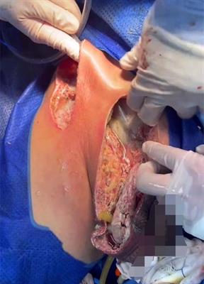 Extensive necrotizing fasciitis of scrotum and abdominal wall: Report of two cases and a review of the literature
